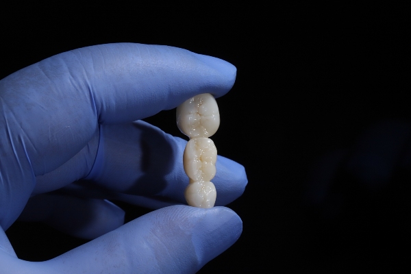 The Different Types Of Dental Bridges: Finding The Perfect Fit